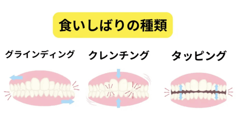 歯ぎしりの種類