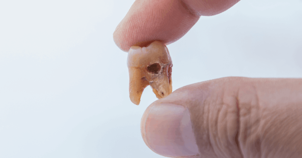 歯が痛む原因は虫歯だけが原因ではなく、他の歯のトラブルも関係している