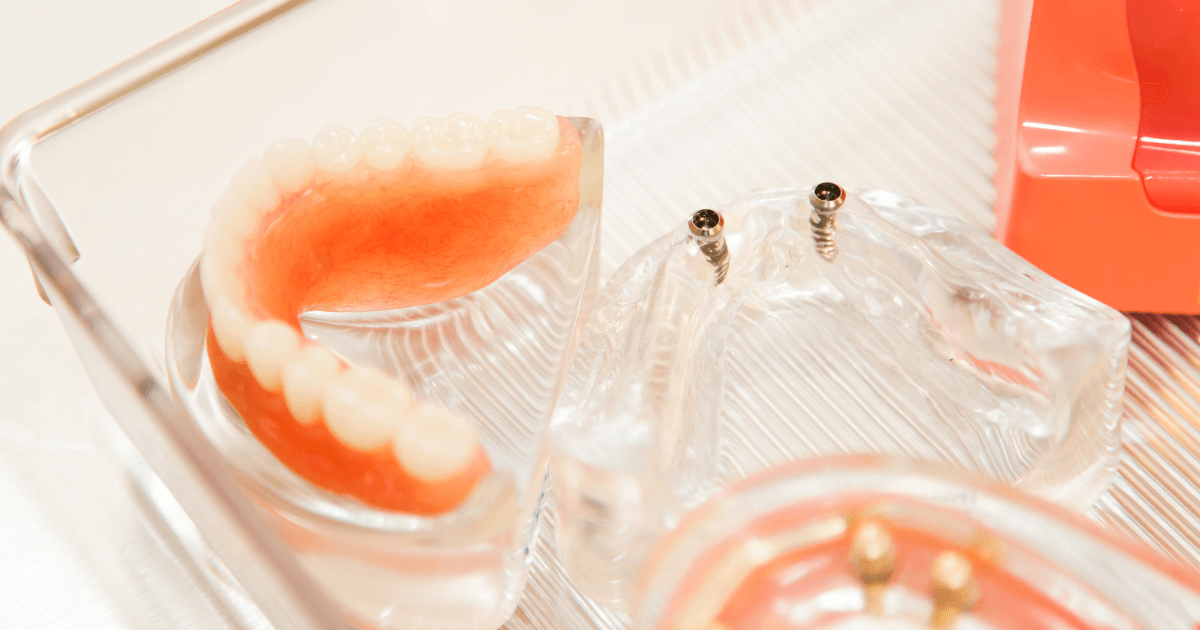 インプラント治療中の歯がない期間の対処法