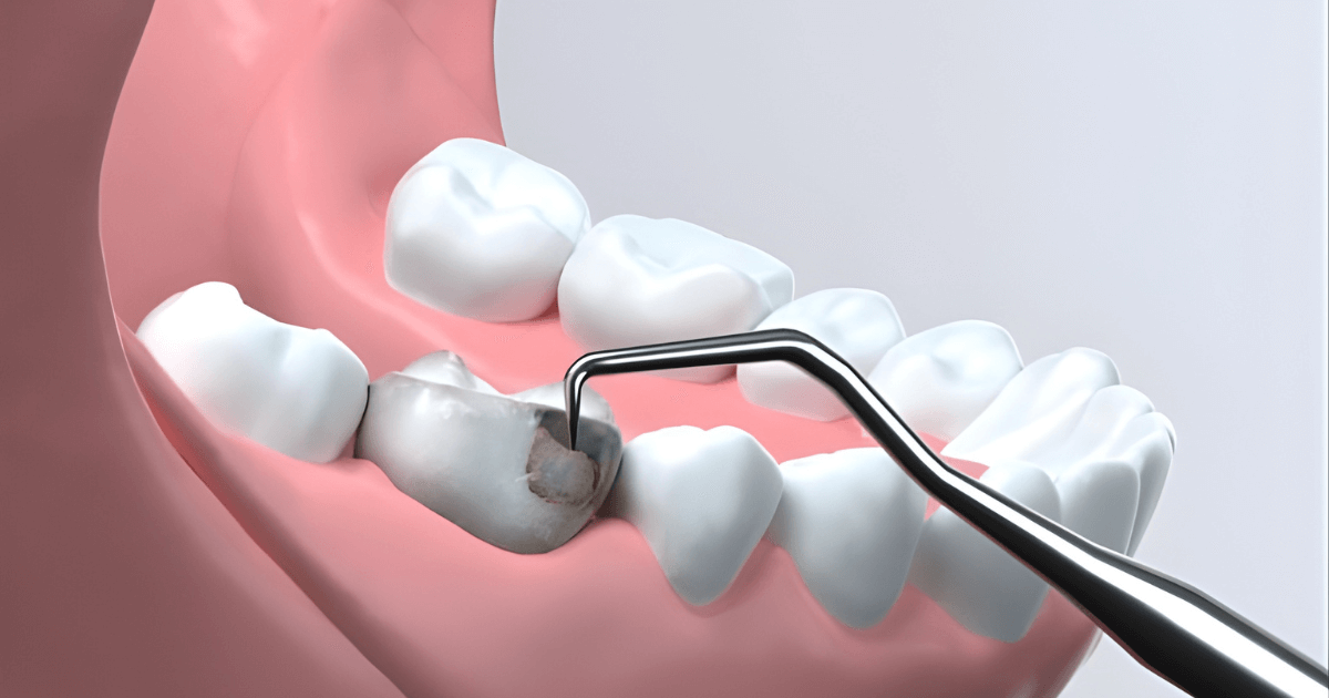 虫歯　歯が欠けた　治療法
