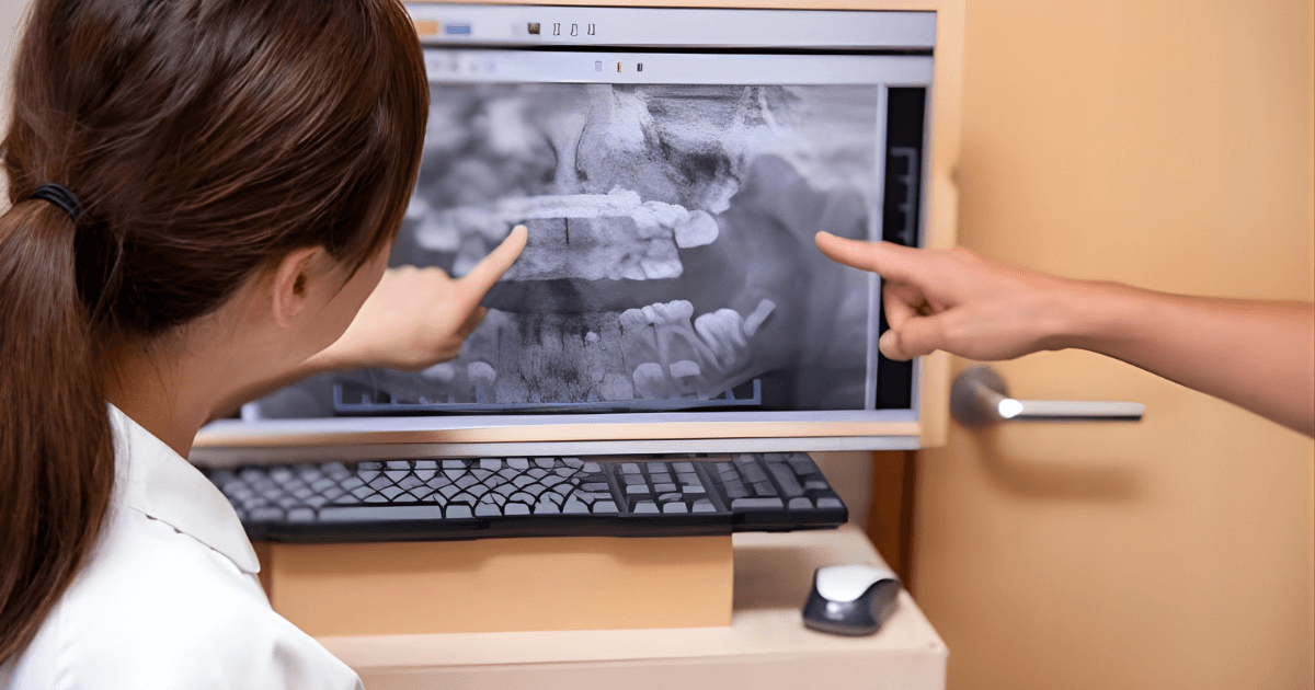 ラミネートベニア　デメリット