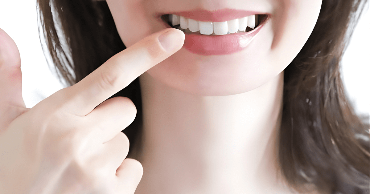 ラミネートベニアとは
