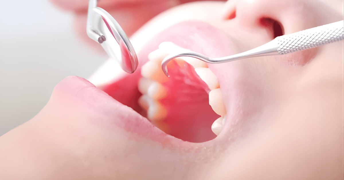 ラミネートベニア　基本