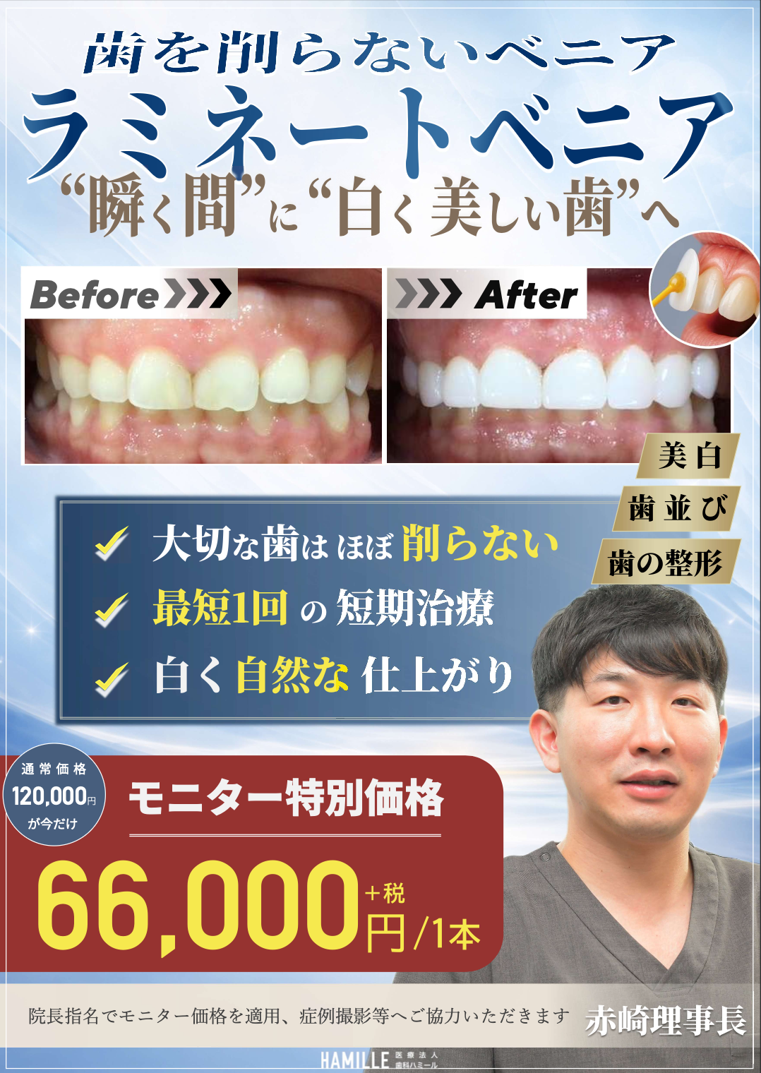 【4月スタート】歯を削らない「ラミネートベニア」特別モニター募集のお知らせ