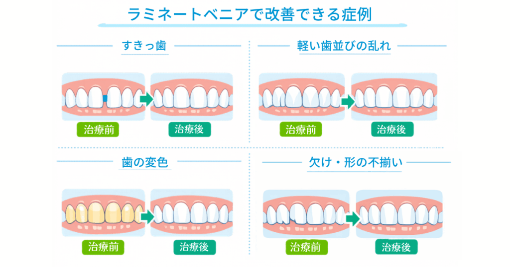 ラミネートべニアで治療できる症例を紹介する図