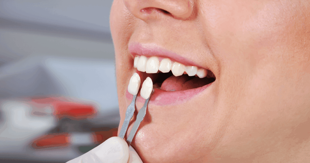 前歯2本のラミネートべニア治療