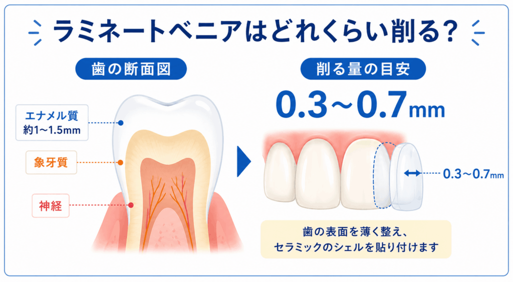 ラミネートベニア治療での削る量を説明する図
